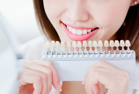 Kozmetické bielenie zubov